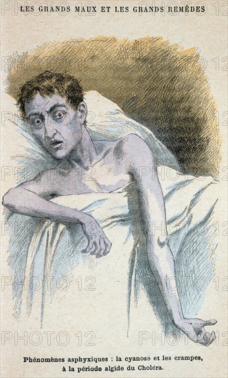 Cholera
Patient in typical cholera attitude