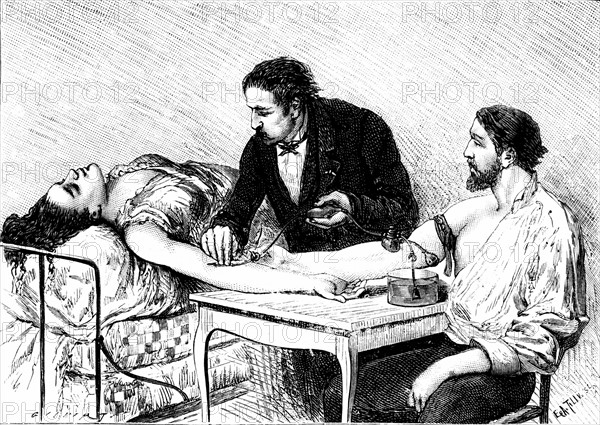 Transfusion sanguine, le 7 fevrier 1882