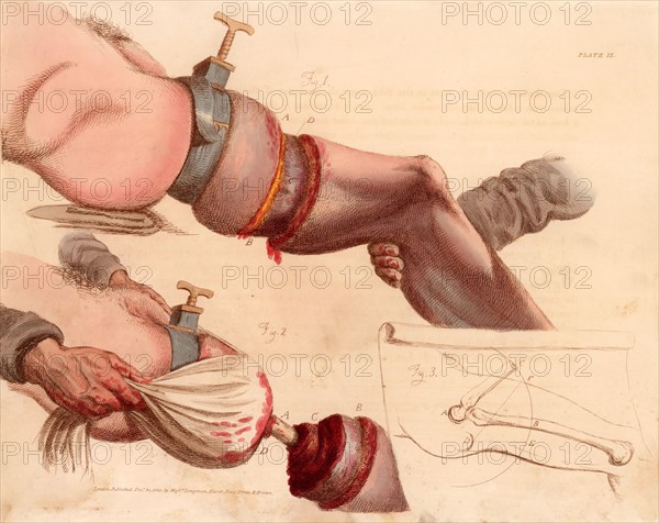 Amputation of the leg at the thigh