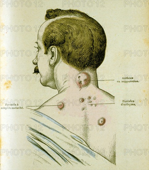 Development of pustules in a man suffering from Anthrax