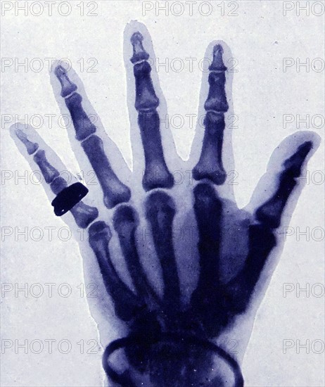 X-Ray halftone presentation of a full hand with ring