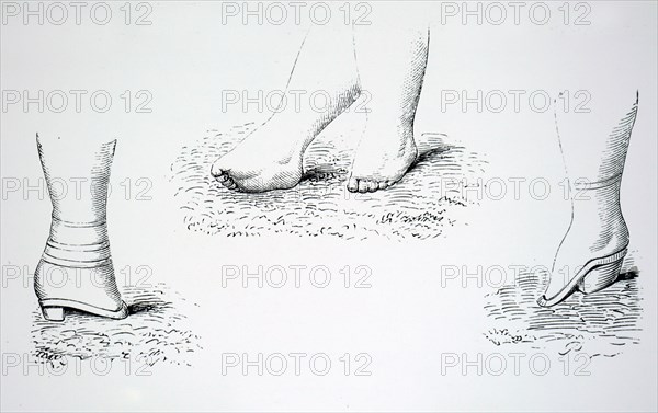 Damaged feet caused by foot binding in China