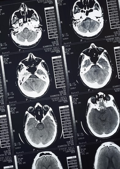 CT Scan of a human male brain