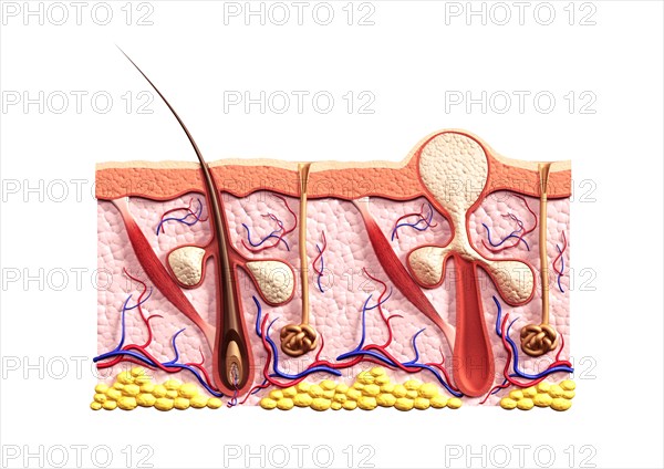 Cross section of skin showing structure of a healthy hair follicle with and sebaceous glands and a whitehead acne pimple filled with sebum