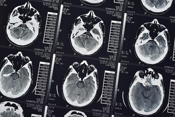 CT Scan of a human male brain