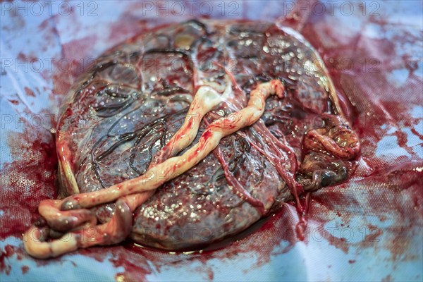 Placenta outside uterus just after childbirth in the hospital