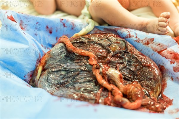 Placenta outside uterus just after childbirth and the baby in the background