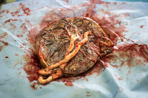 Placenta outside uterus just after childbirth in the hospital