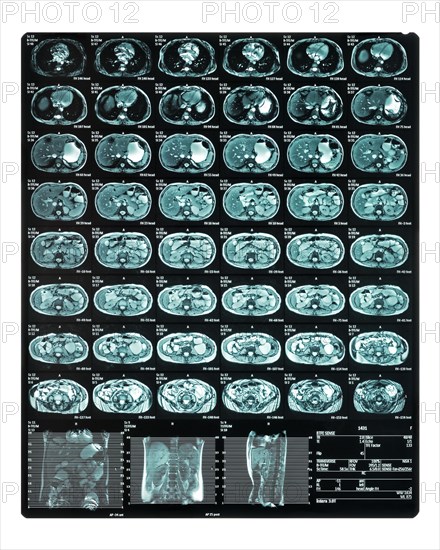 MRI scan