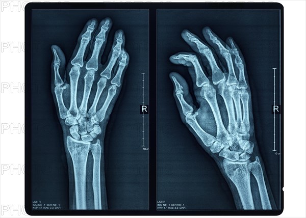 Hand X-ray of an adult female