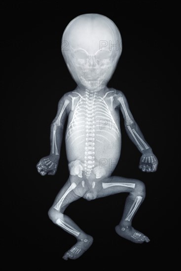 X-ray of a baby