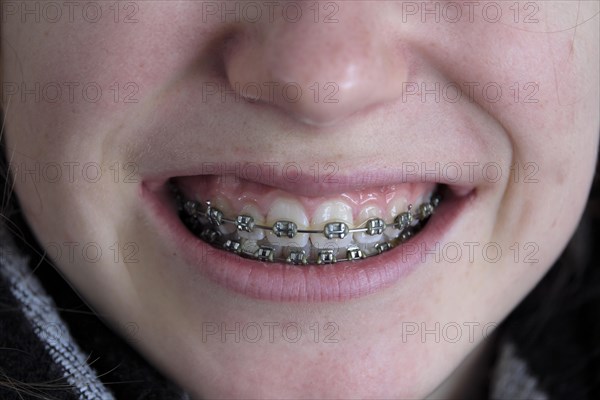 Fixed Braces