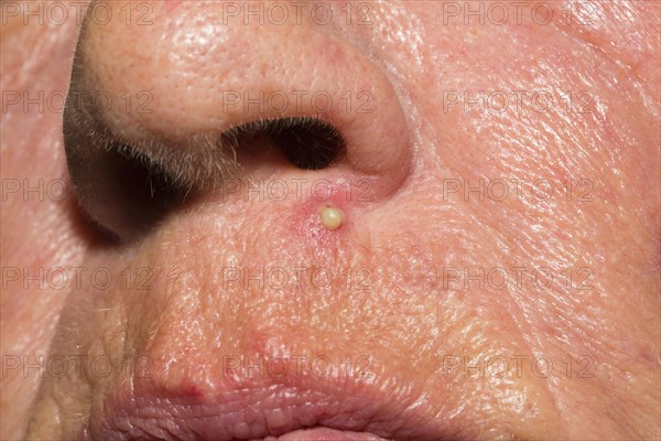 Inflamed pore below the nose of a woman