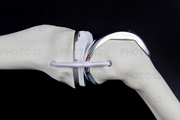 Knee prosthesis