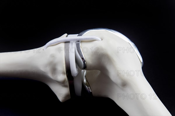 Knee prosthesis