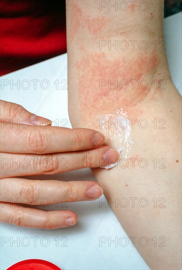 Woman applying ointment to eczema at the elbow