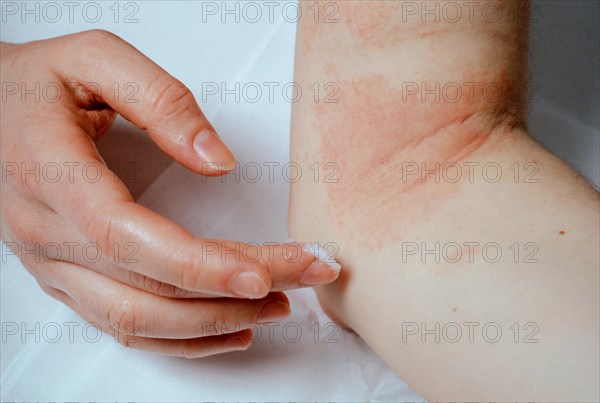 Woman applying ointment to eczema at the elbow
