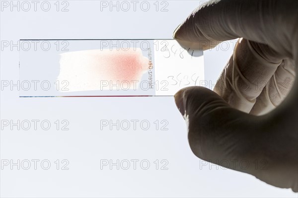 Blood smeared on a glass slide for diagnosis