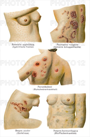 Skin diseases