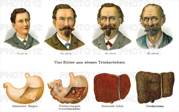 Visual development of an alcoholic throughout life