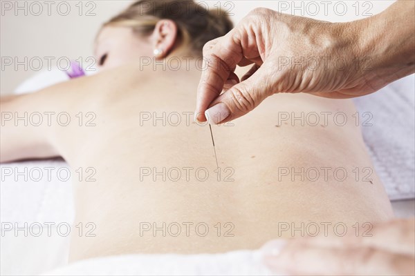 Young woman receiving acupuncture treatment on her back