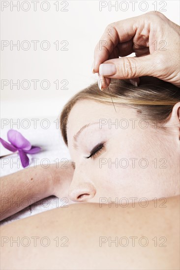 Young woman receiving acupuncture treatment on her head