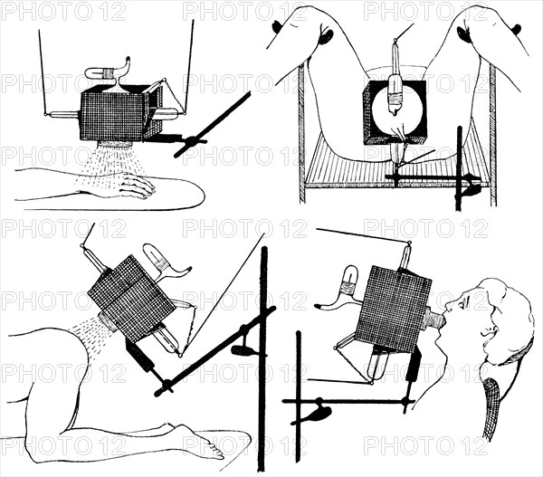 Irradiation of the hand