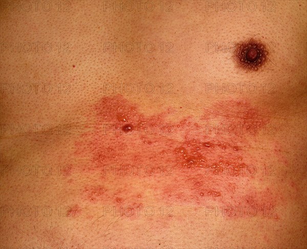 Shingles or herpes zoster in the chest area of a man