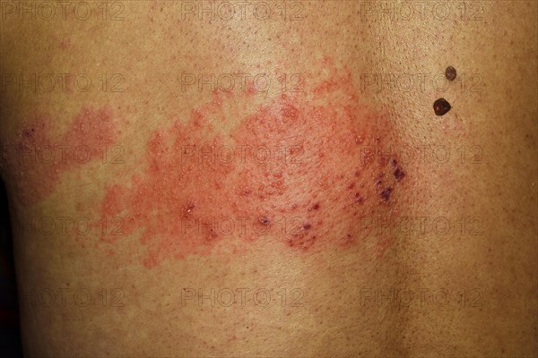 Shingles or herpes zoster