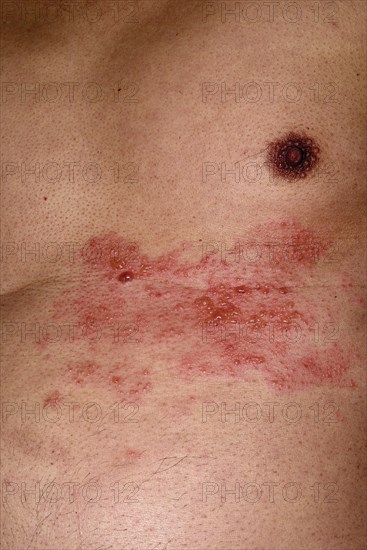 Shingles or herpes zoster in the chest area of a man