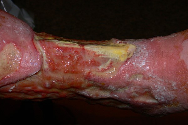 Smoker's leg"" with Squamous-cell carcinoma of the lower leg