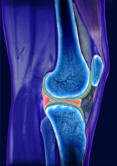 Meniscus