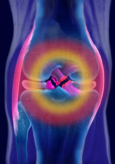 Rupture of both cruciate ligaments