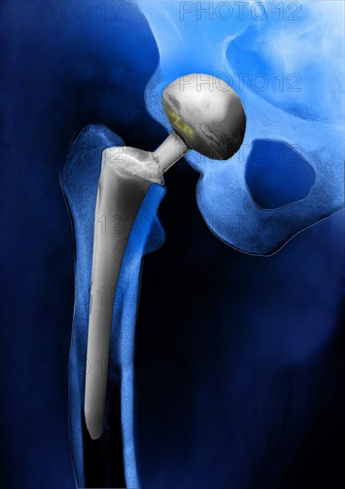 Hip prosthesis