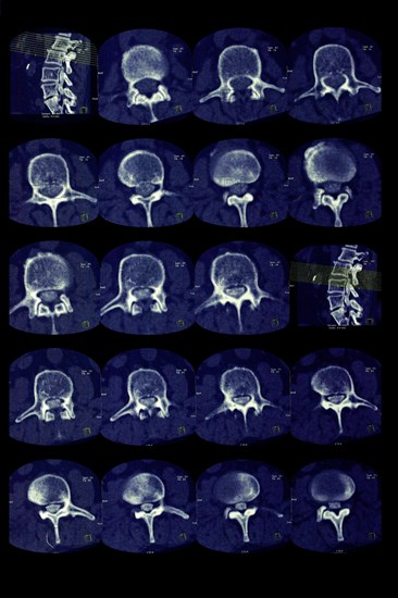 Lumbar vertebrae