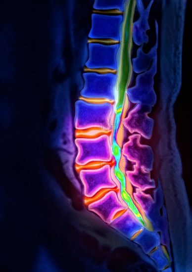 Herniated disk