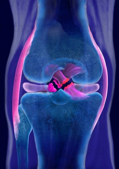 Rupture of both cruciate ligaments