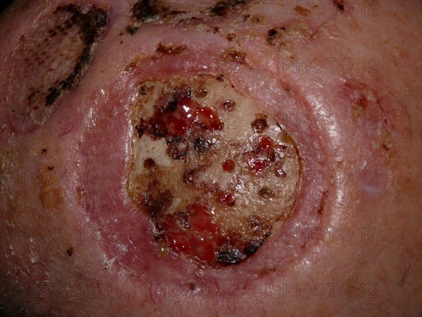 Squamous-cell carcinoma of the scalp