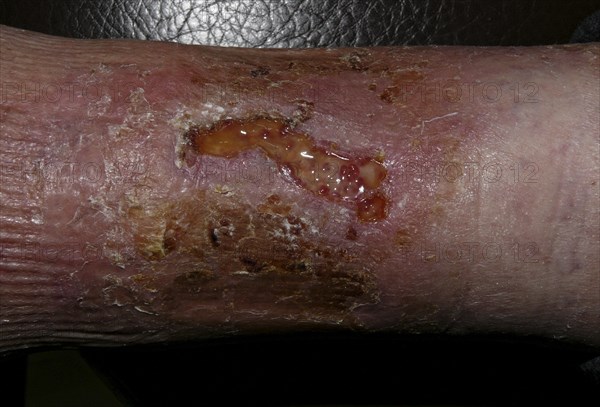 Infected bite wound of the lower leg