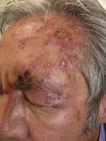 Herpes zoster ophthalmicus