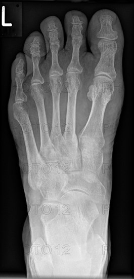 X-ray