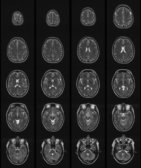 MRT scan