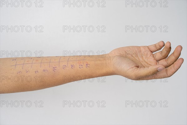 Allergy test