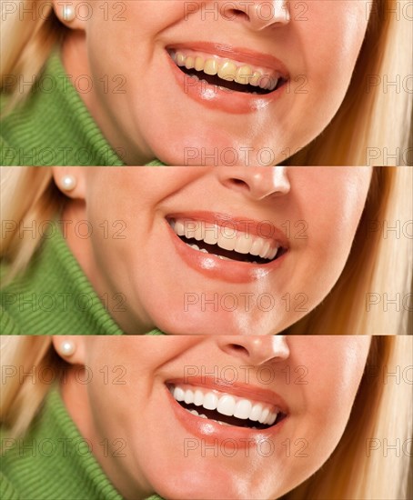 Smiling female showing progressive teeth whitening and bleaching