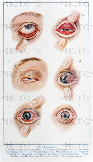 Various eye diseases