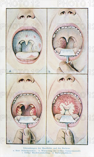 Diseases of the oral cavity