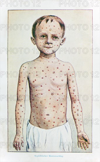 Skin rashes in syphilis