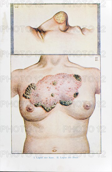 Lupus of the nose and lupus of the breast