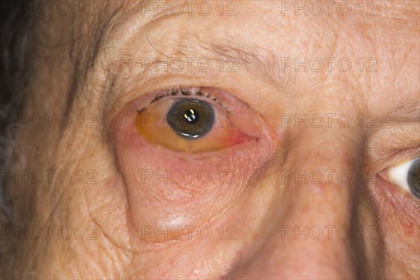 Infectious conjunctivitis