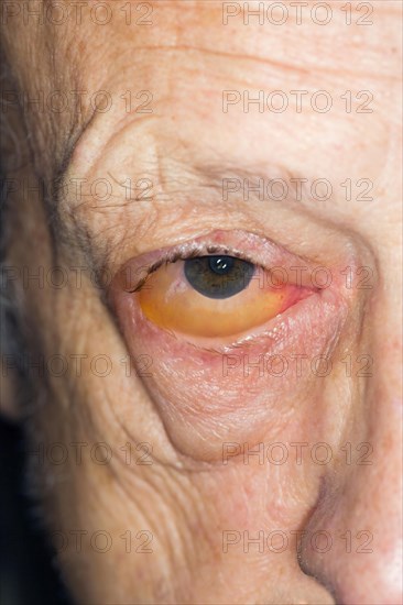 Infectious conjunctivitis